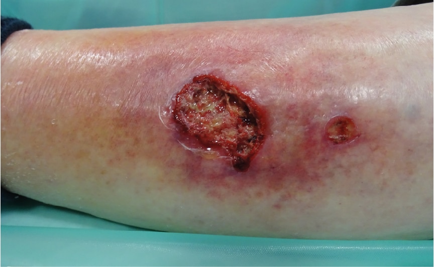 ferida infectada Ferida traumática infectada na parte inferior da perna